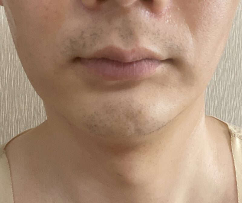 40代おじさんヒゲ医療脱毛、2回目行ってきました！